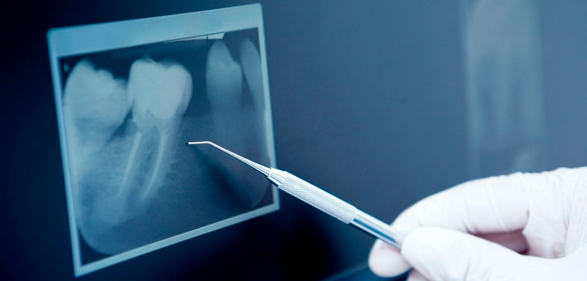 precio de una endodoncia
