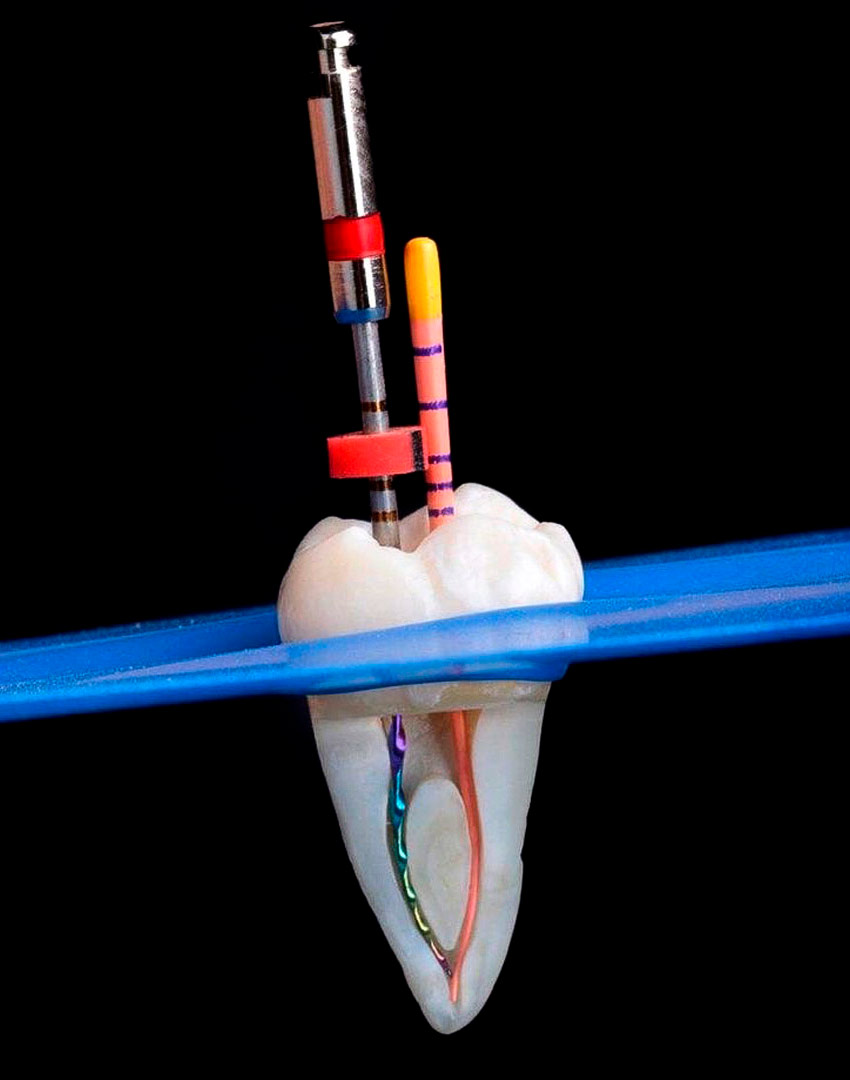 como se realiza una endodoncia