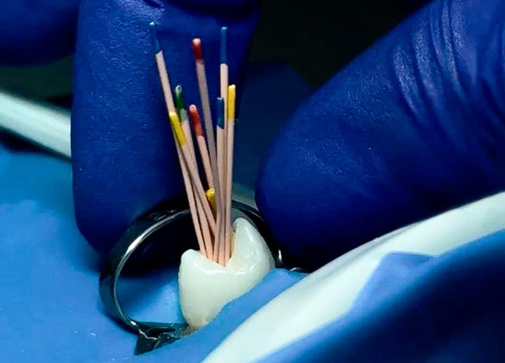 como se realiza una endodoncia obturacion