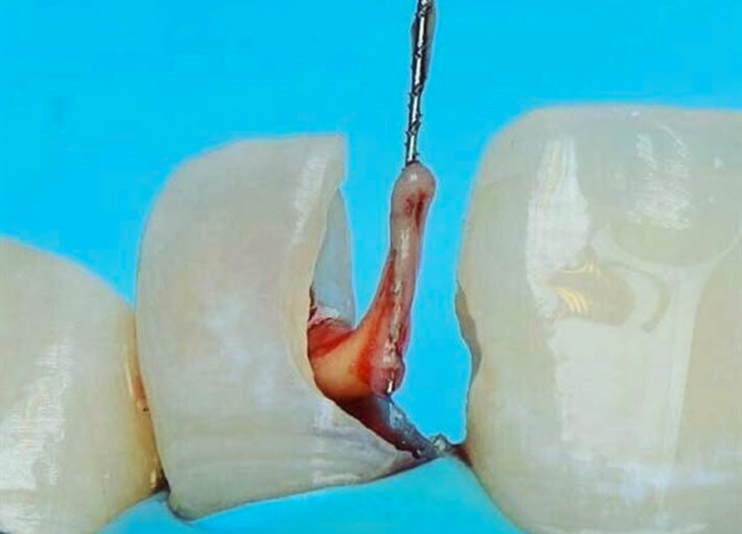 extracción de pulpa dental