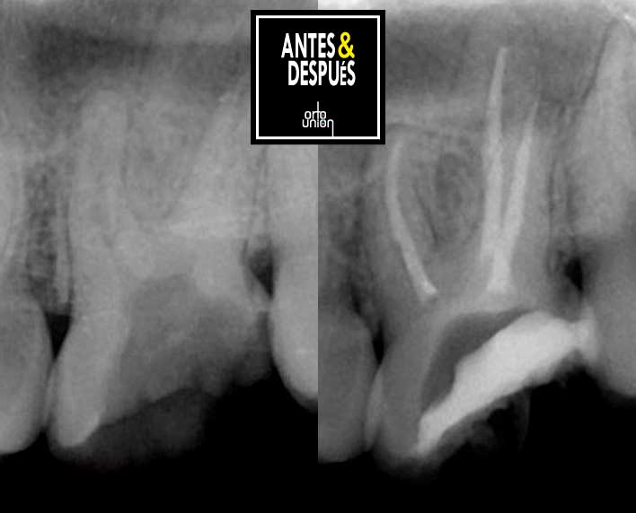 endodoncia multirradicular en medellin