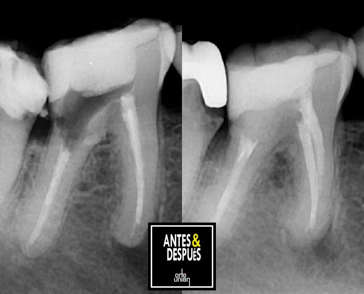 reendodoncia-medellin