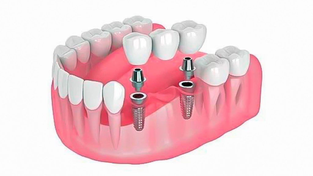 puentes fijos sobre implantes dentales multiples