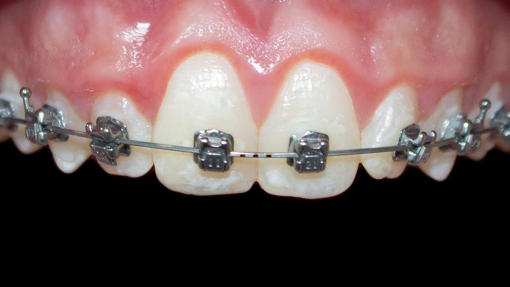 brackets autoligado medellin