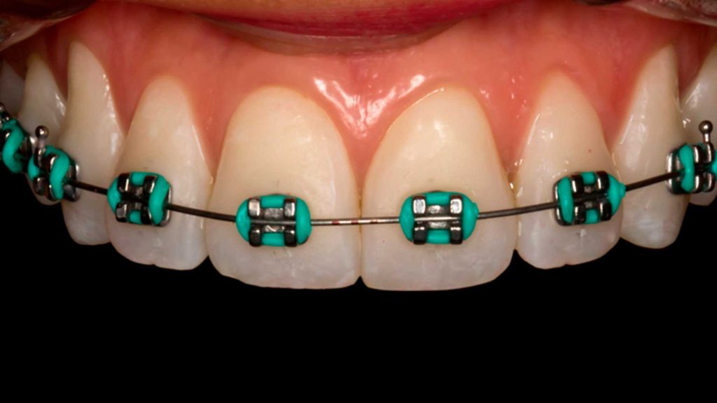 brackets metalicos