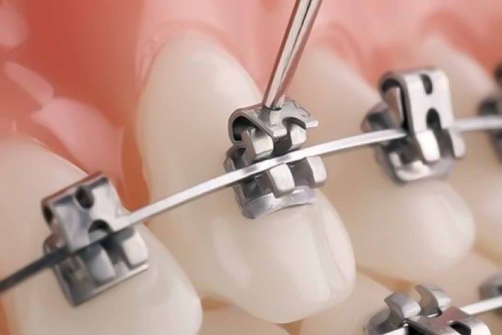 como funcionan los brackets de autoligado