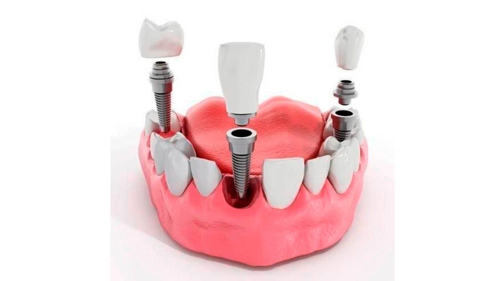 coronas individuales sobre implantes dentales multiples