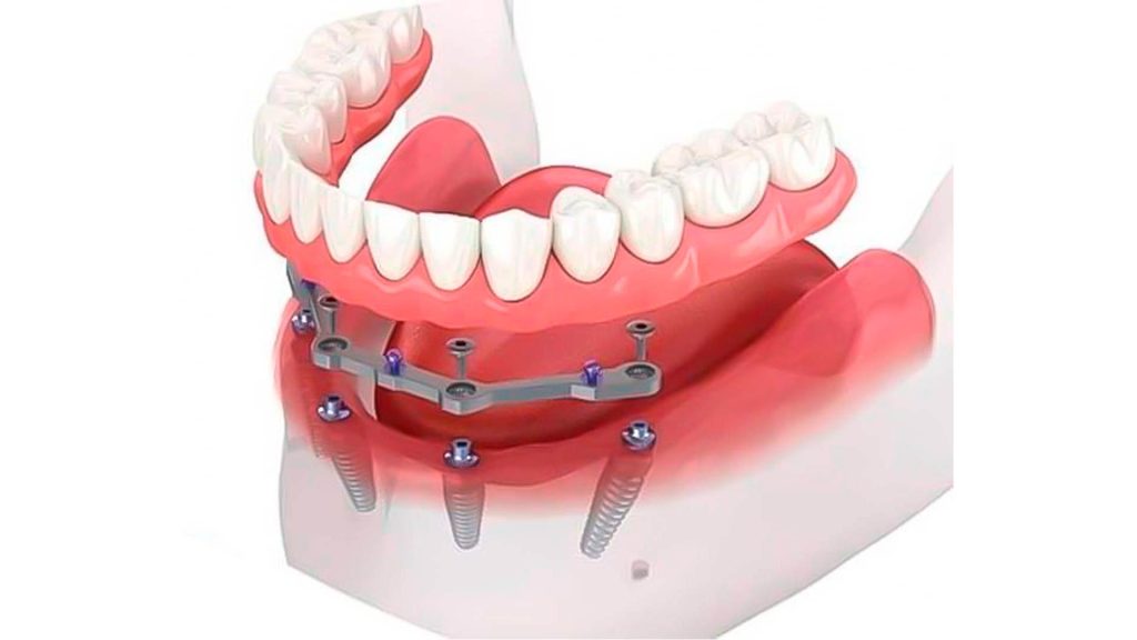 sobredentadura removible sobre implantes multiples