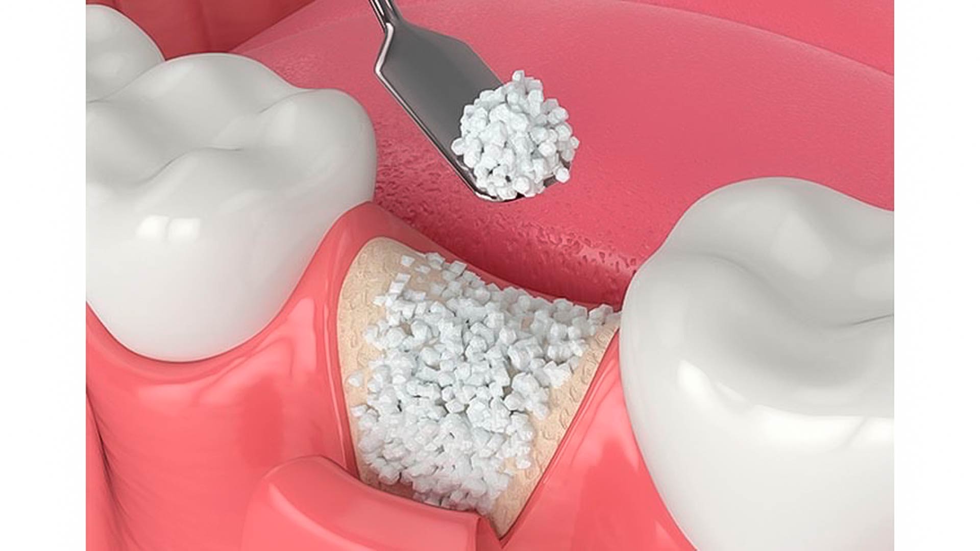 injerto dental oseo