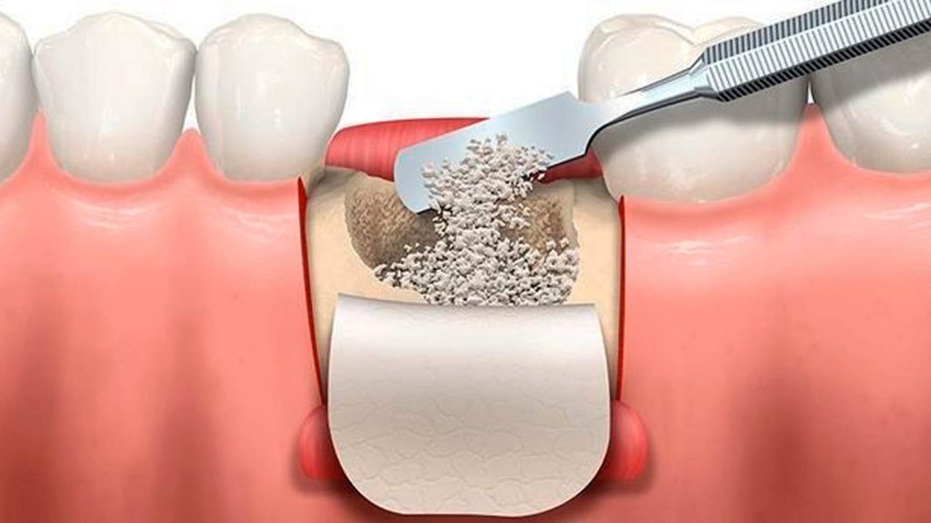 injerto oseo dental