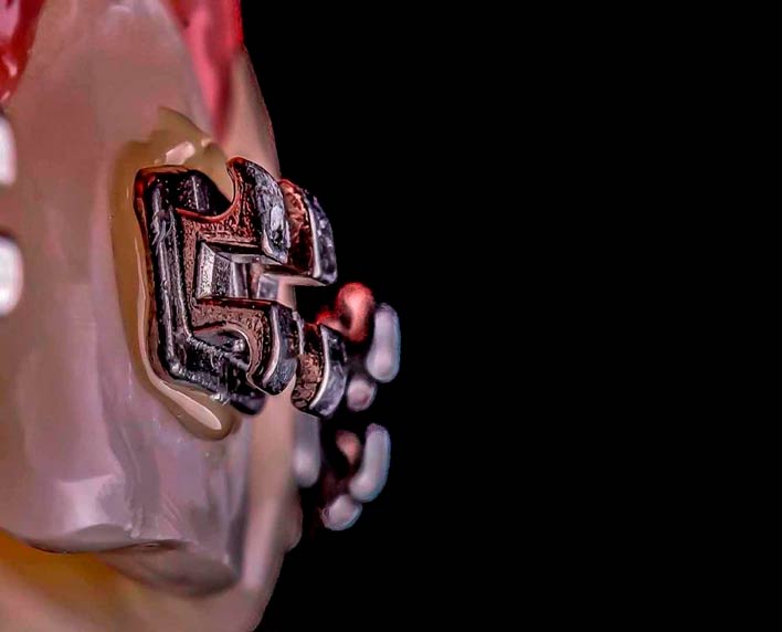 porque elegir brackets metalicos