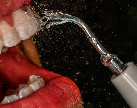 limpieza dental en medellin