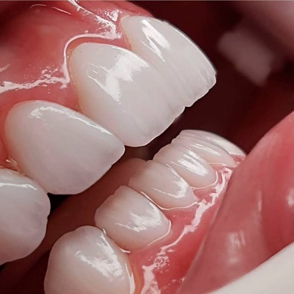 limpieza dental profesional en medellin