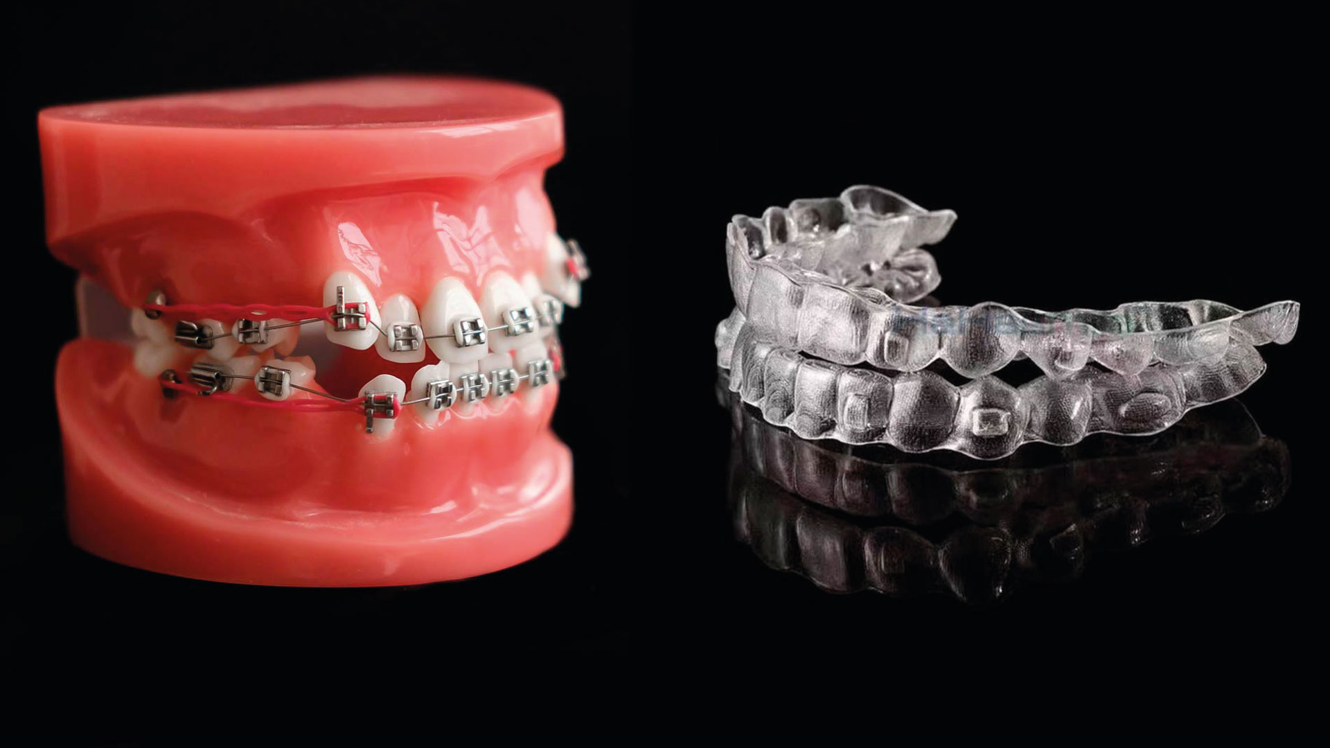 Comparación entre Brackets y alineadores transparentes para un tratamiento de Ortodoncia