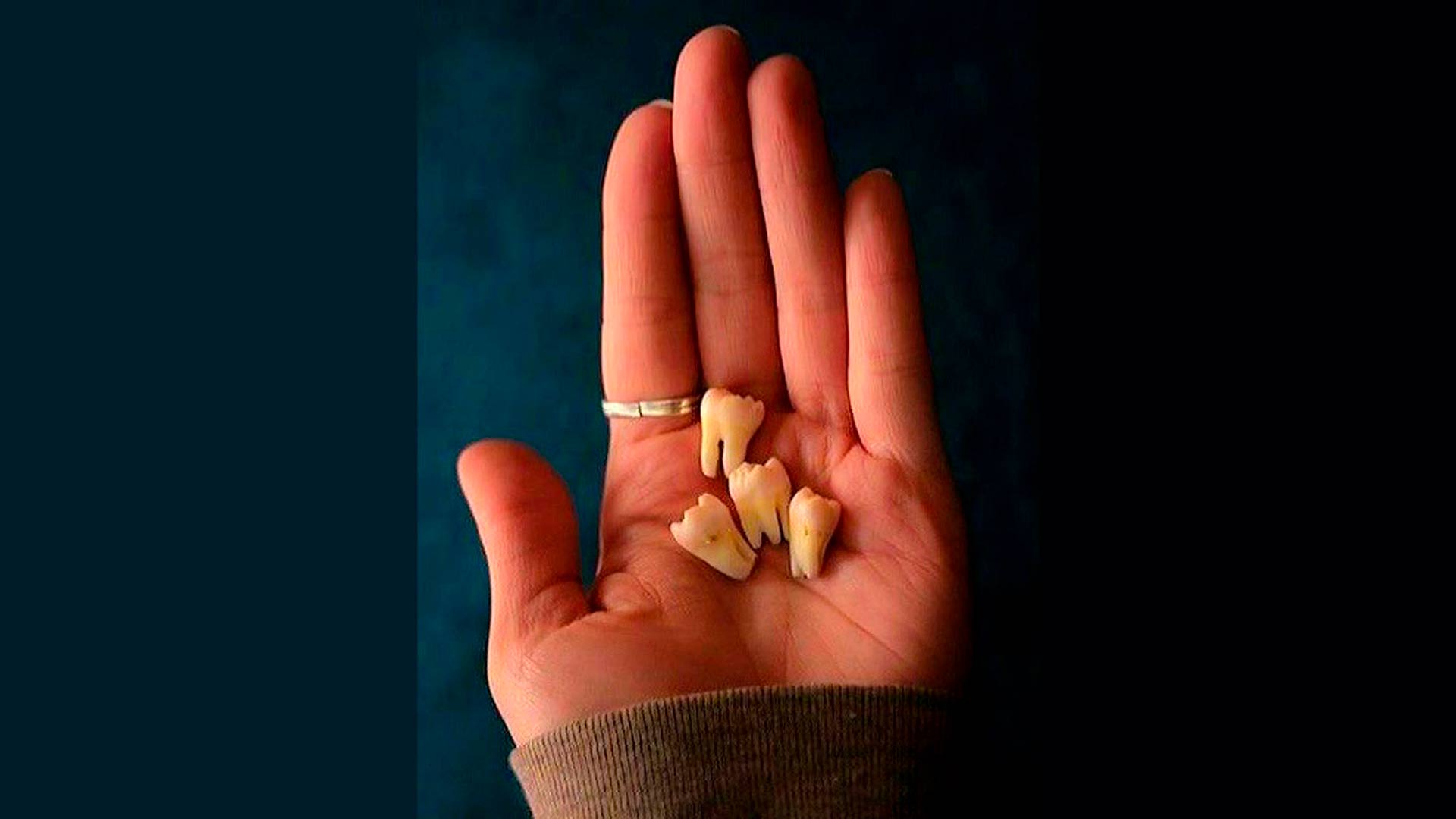 cuanto cuesta una extraccion de cordales en medellin