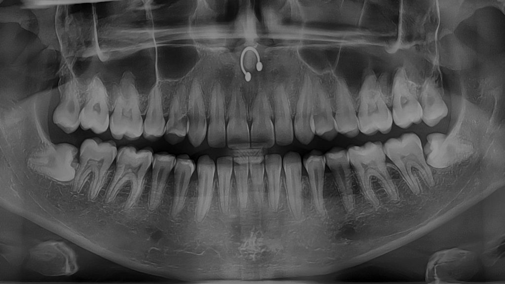 Radiografía panorámica para evaluar la posición de las Cordales