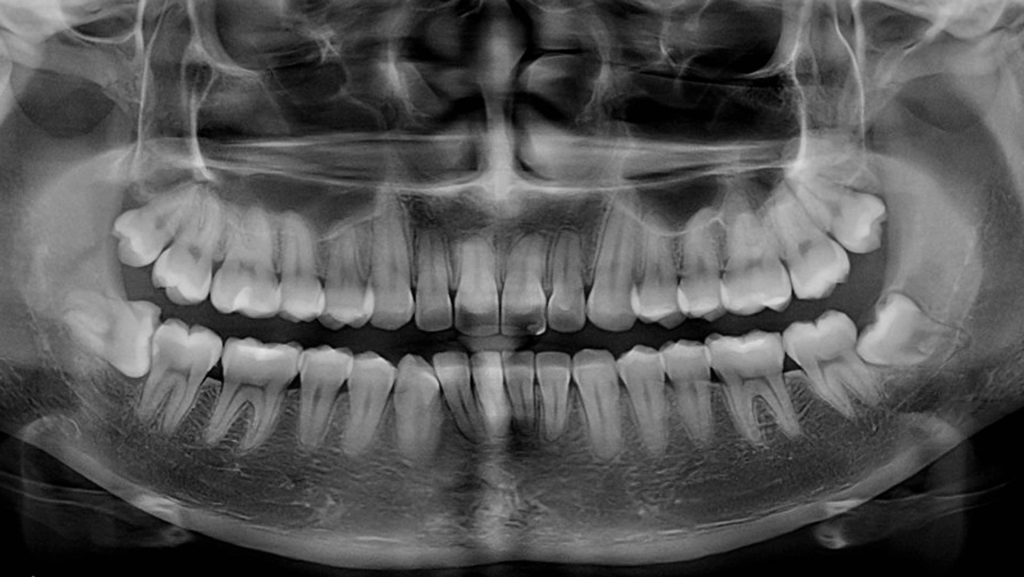 Radiografía panorámica para evaluar el precio de la extracción de Cordales en Medellín