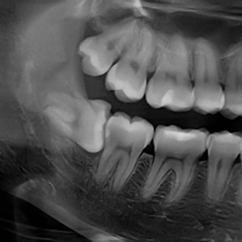 Radiografía panorámica con una Cordal inferior horizontal junto al segundo molar