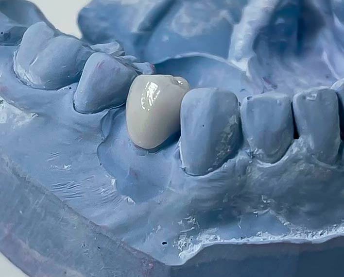 corona dental sobre modelo en yeso