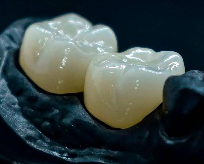 coronas dentales en zirconio para molares inferiores